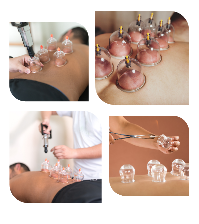 Cupping Therapy